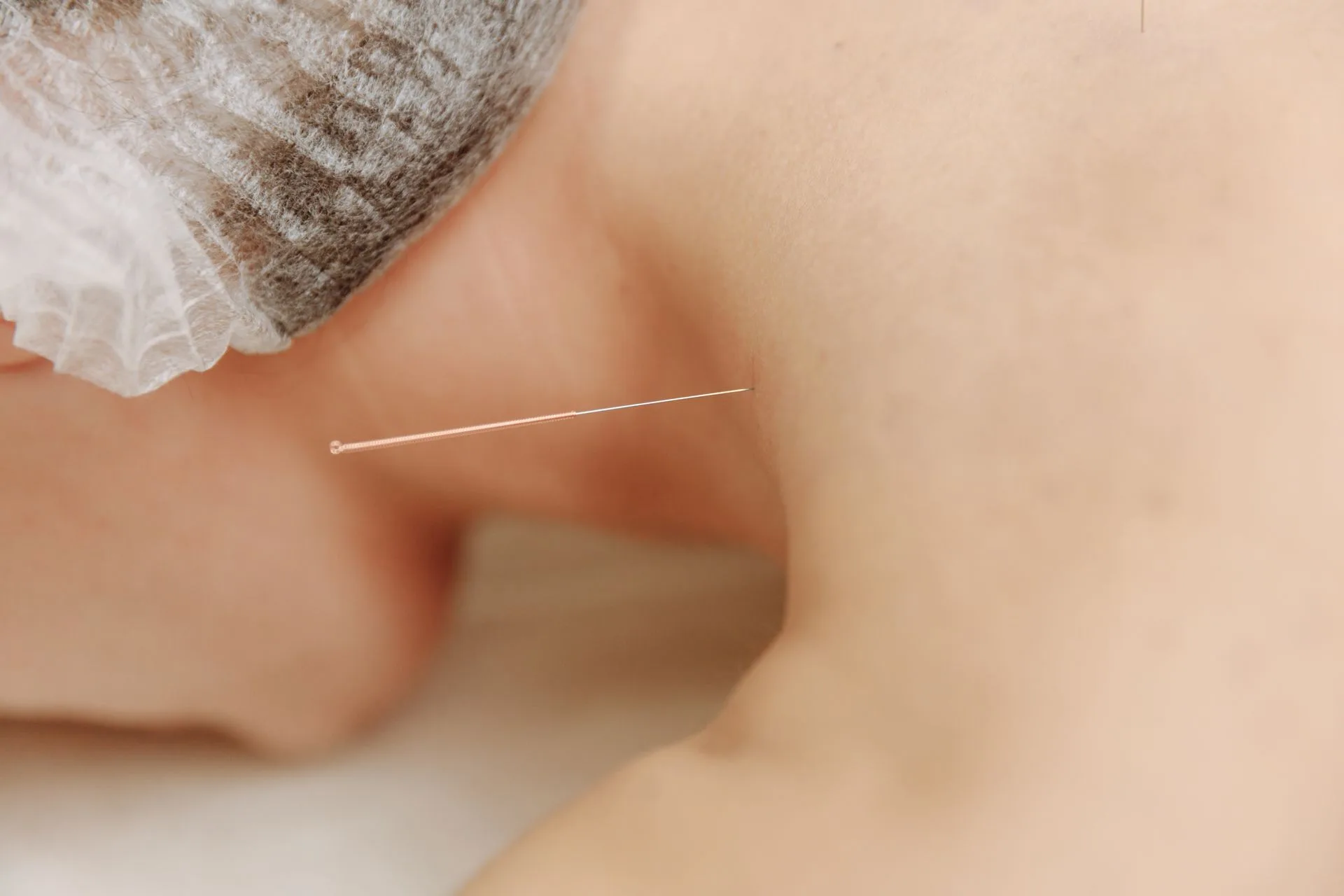 Close-up of a fine acupuncture needle placed near a client's neck and shoulder during treatment