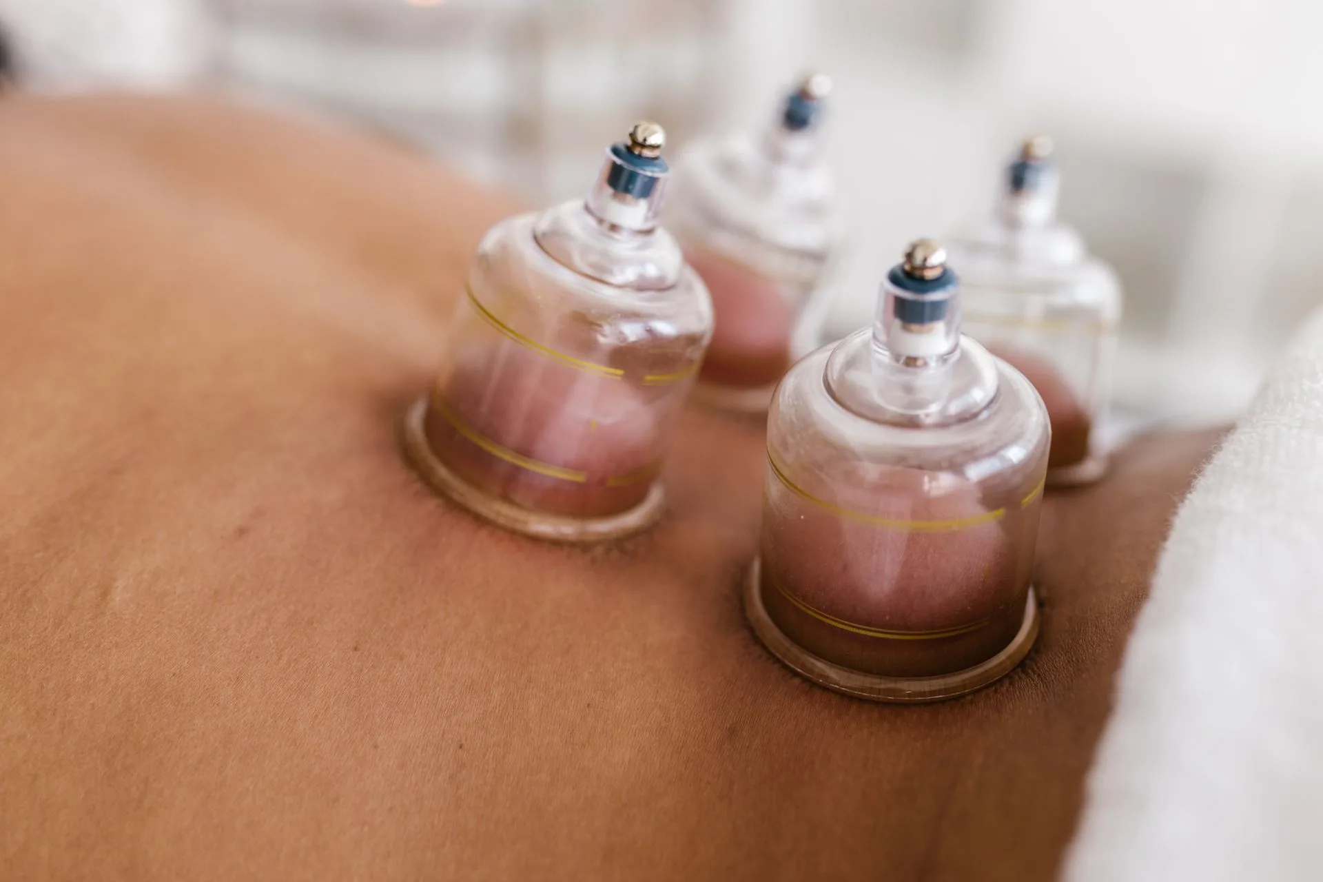 Close-up of glass cupping cups on a client's back